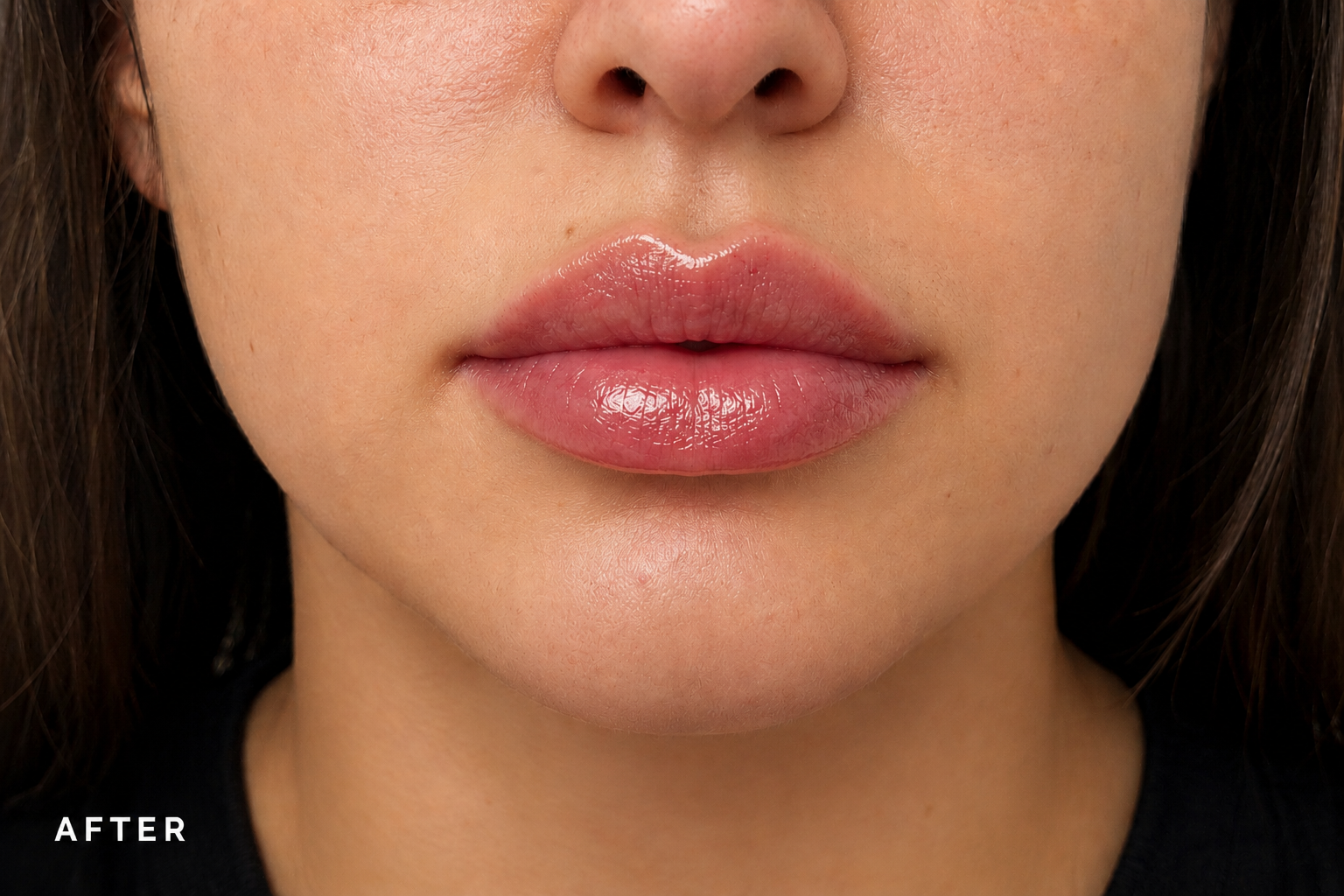 After Treatment
