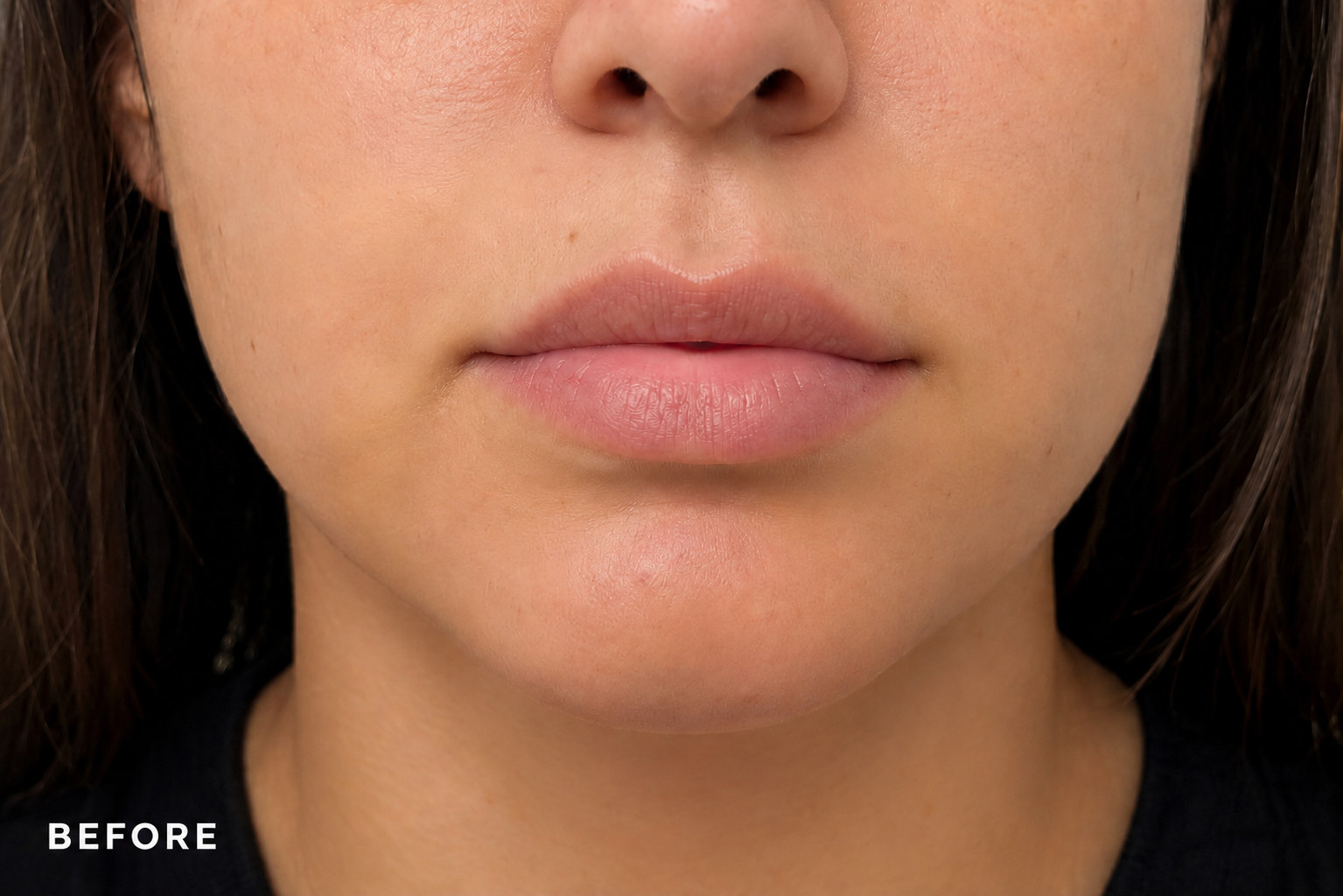 Before Treatment