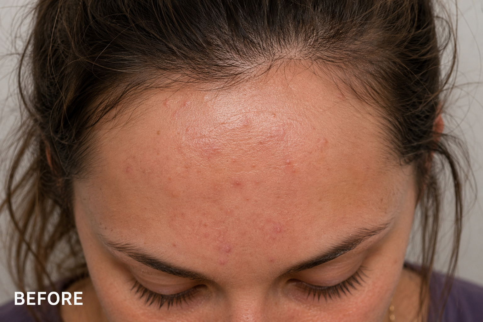 Before Treatment