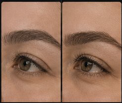 Brow Enhancement