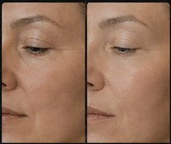 Skin Rejuvenation