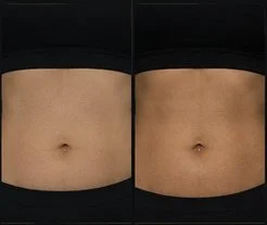 Body Sculpting