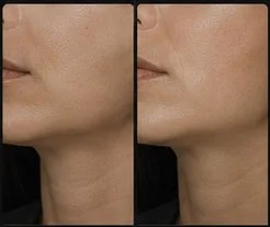 Jawline Contouring