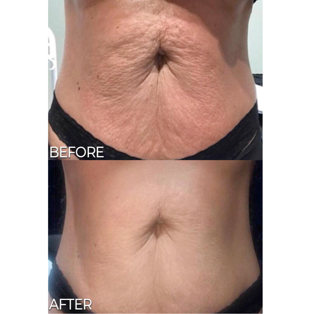 T Shape 2 Abdomen before and after result