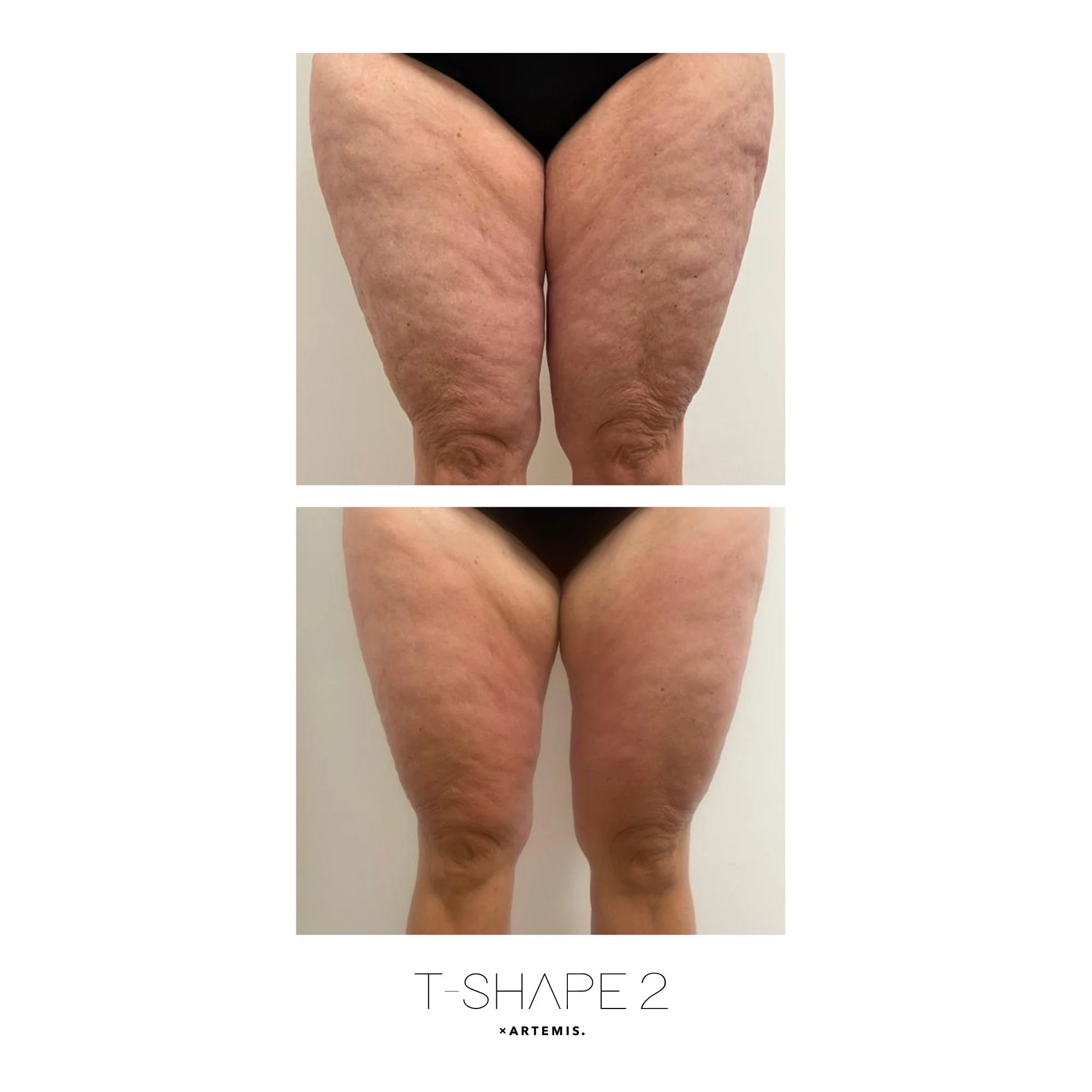 T Shape 2 Legs before and after result