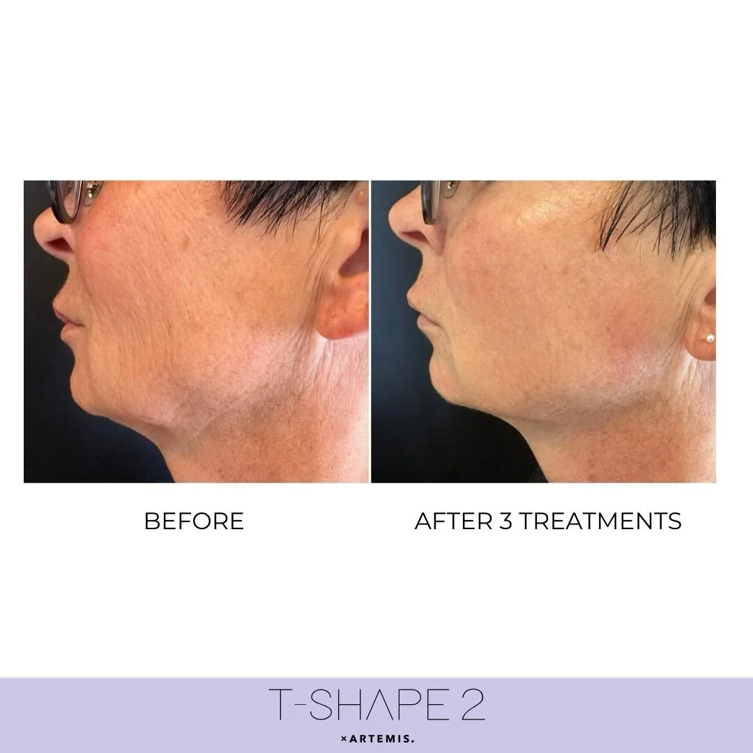 T Shape 2 Face before and after result