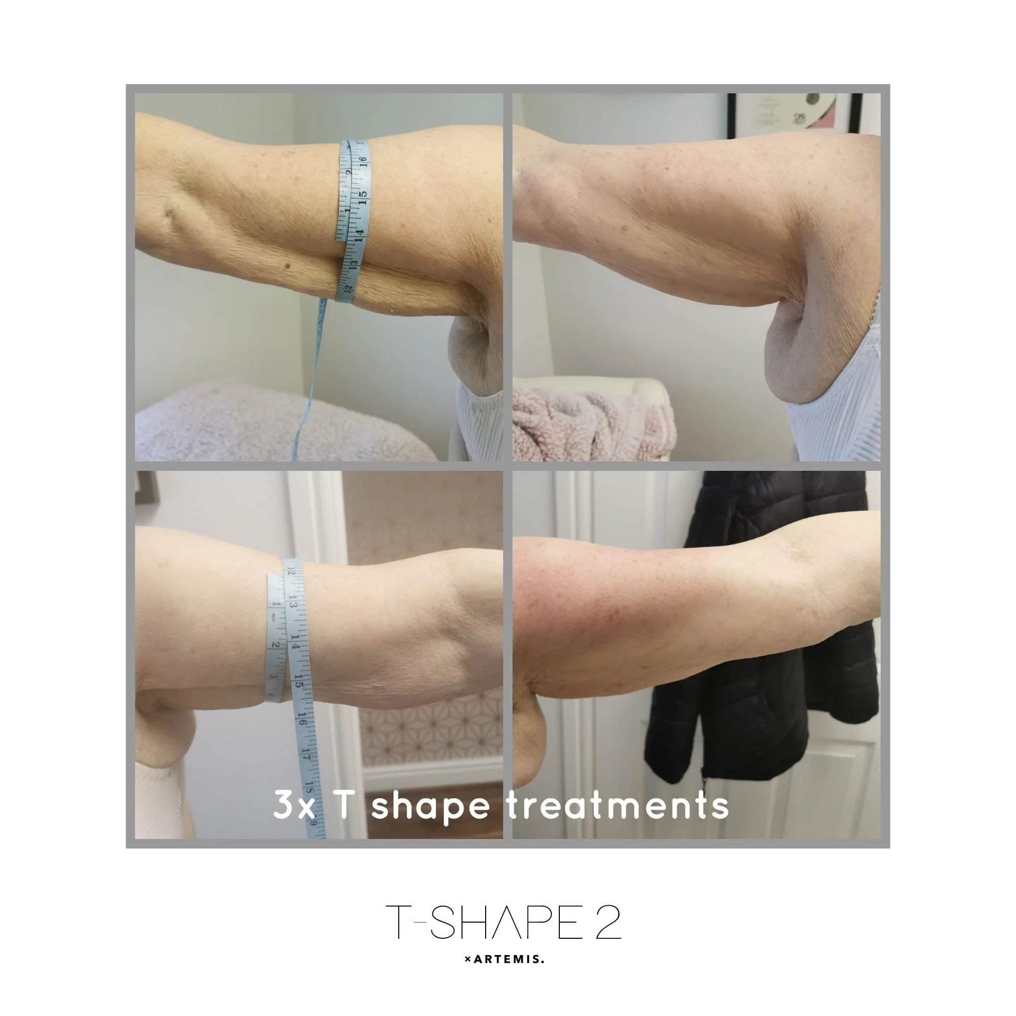 T Shape 2 Arms before and after result