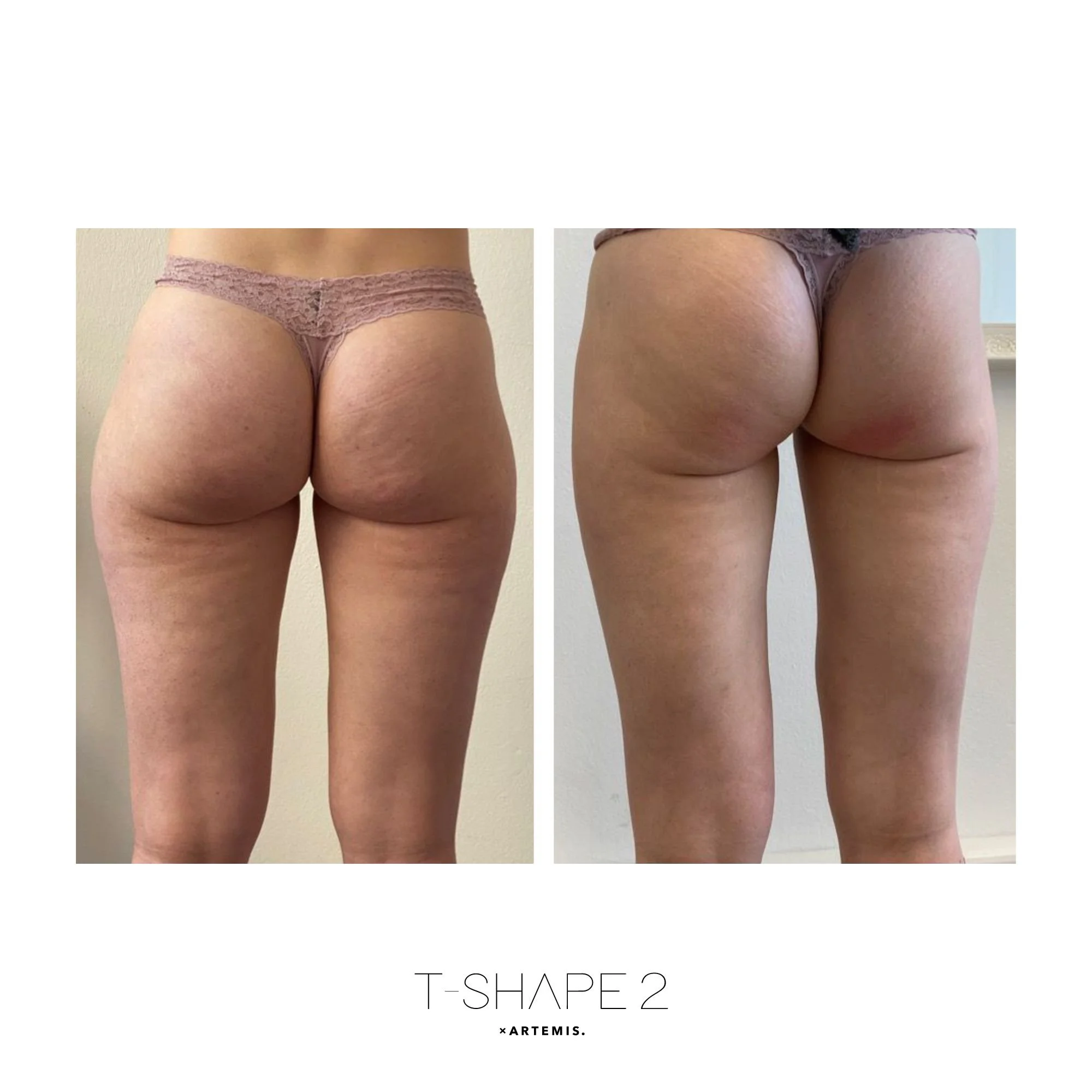 T Shape 2 Glutes before and after result