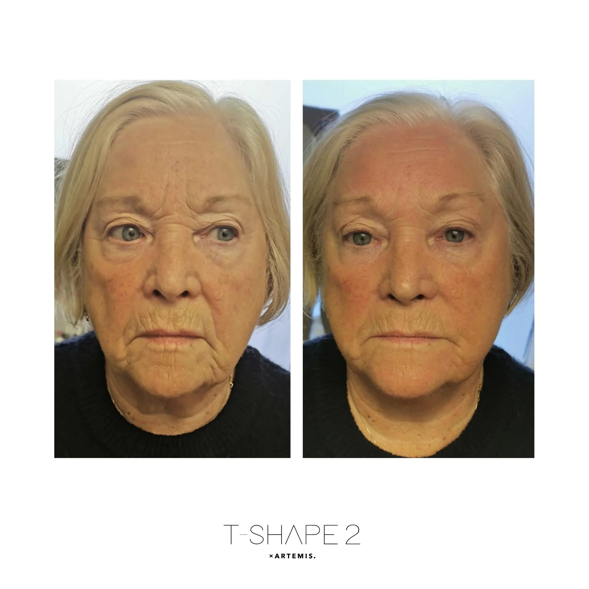 T Shape 2 Face before and after result