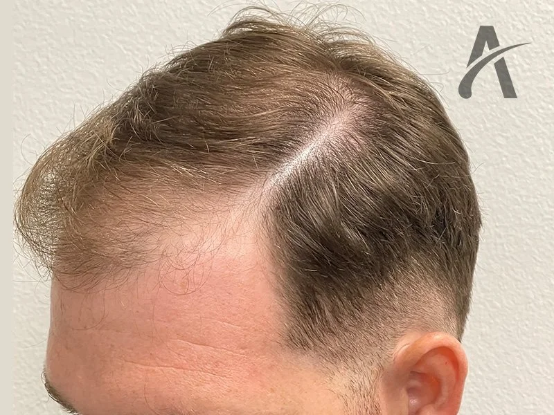 Before 2500 FUE Grafts
