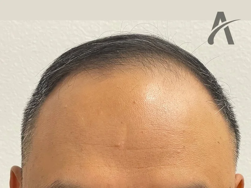 Before 2700 FUE Grafts