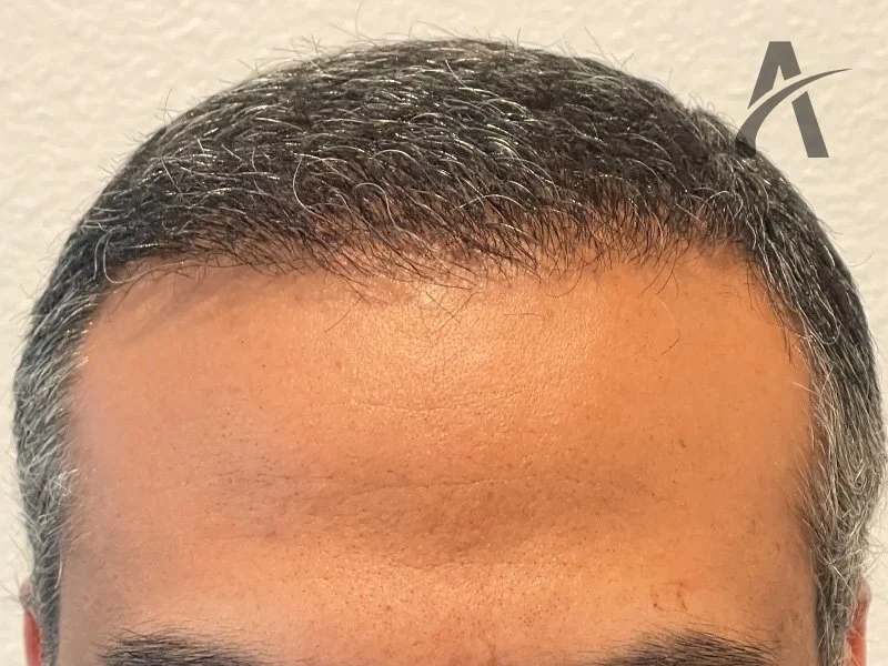 After 2800 FUE Grafts