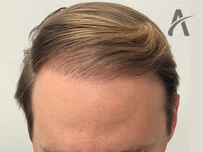 After 2400 FUE Grafts