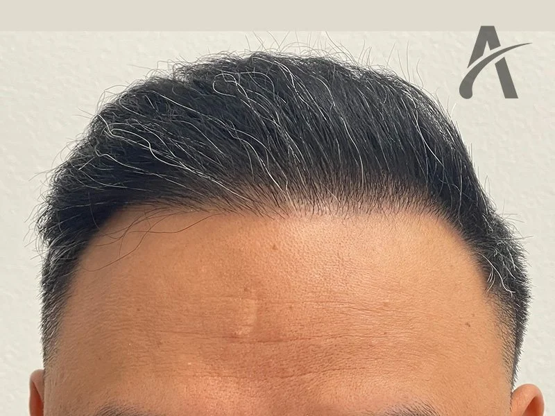 After 2700 FUE Grafts