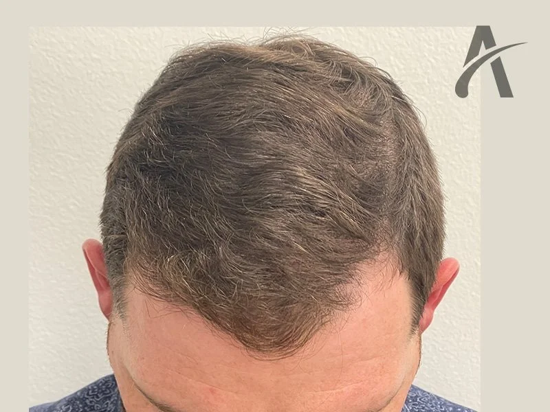After 2500 FUE Grafts
