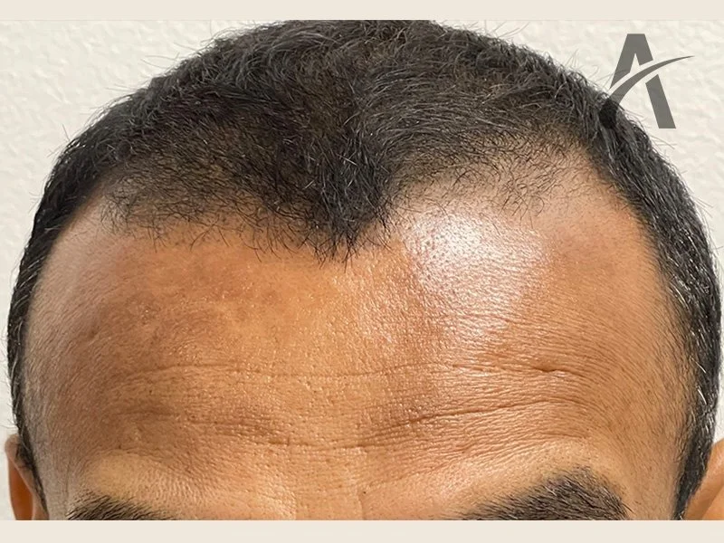 Before 1900 FUE Grafts