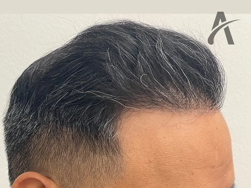 After 2700 FUE Grafts
