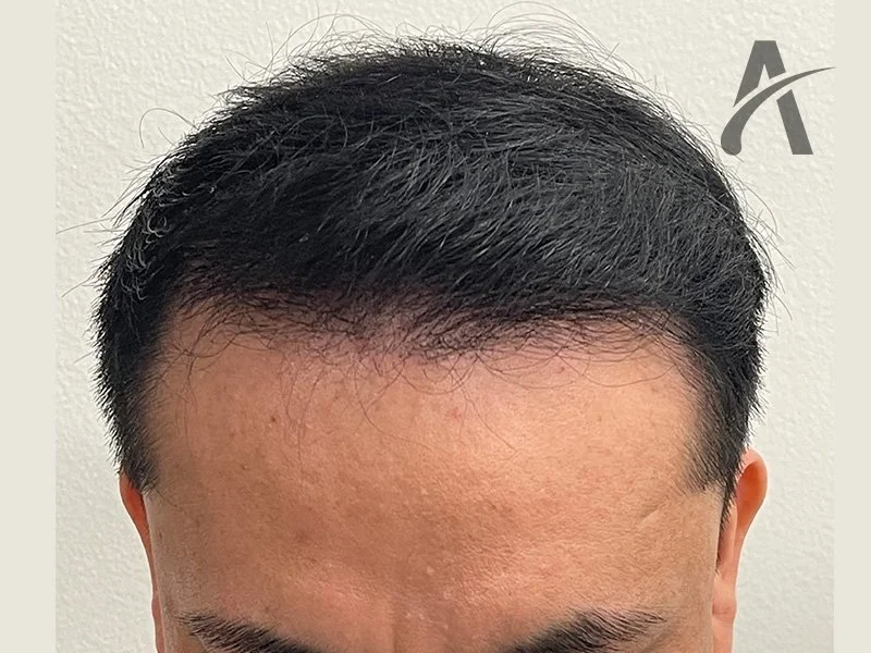After 2500 FUE Grafts