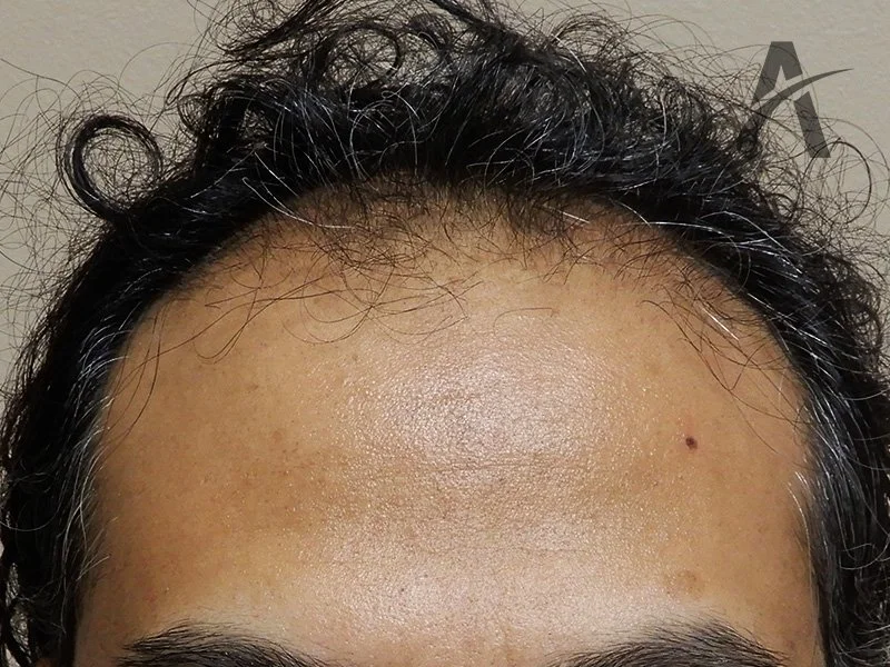 Before 2800 FUE Grafts