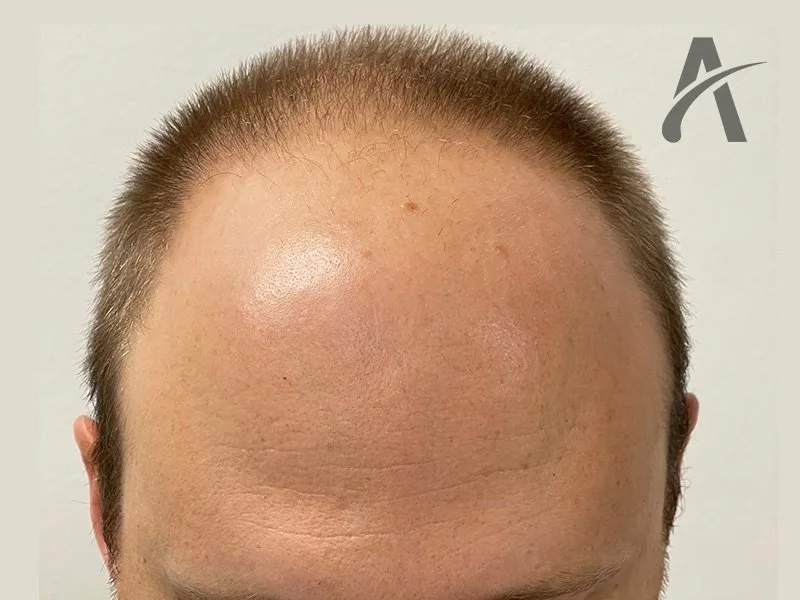 Before 2400 FUE Grafts