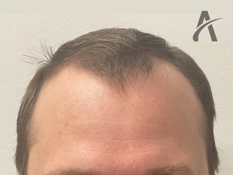 Before 2600 FUE Grafts