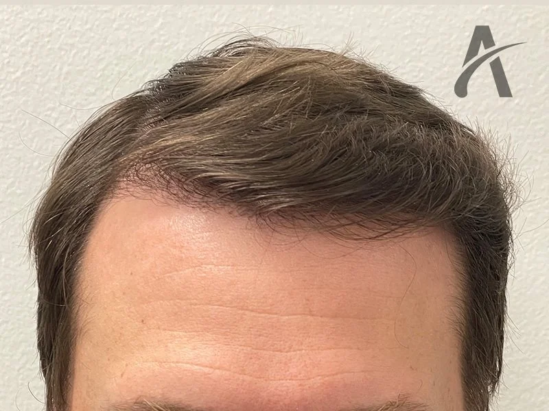 After 2600 FUE Grafts