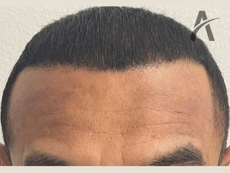 After 1900 FUE Grafts