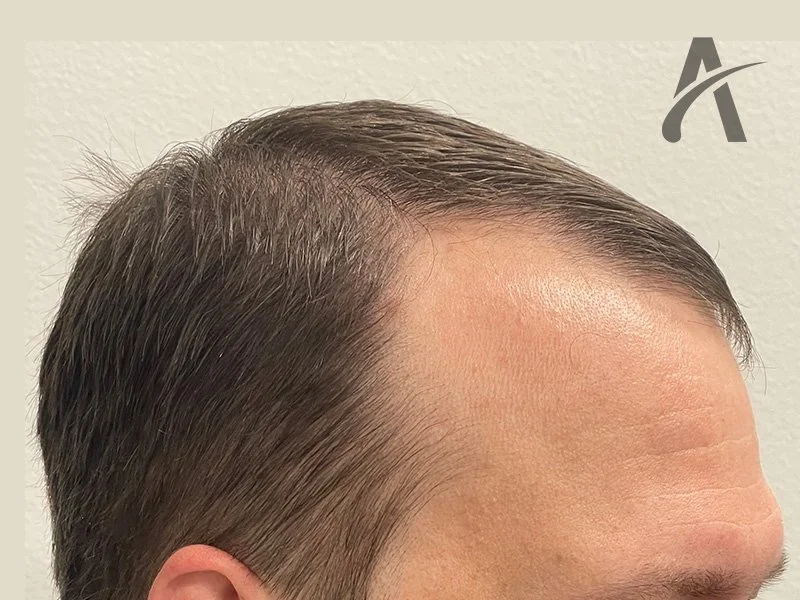 Before 2600 FUE Grafts