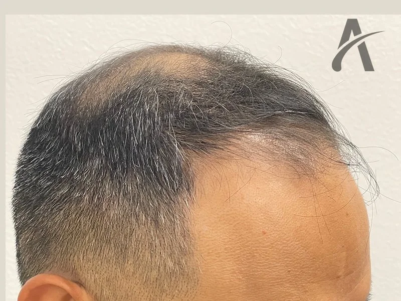 Before 2700 FUE Grafts