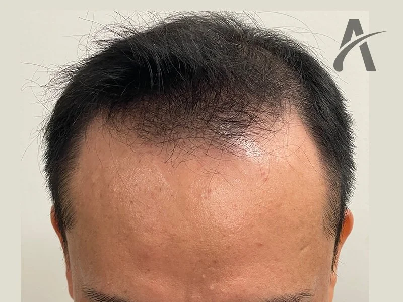 Before 2500 FUE grafts