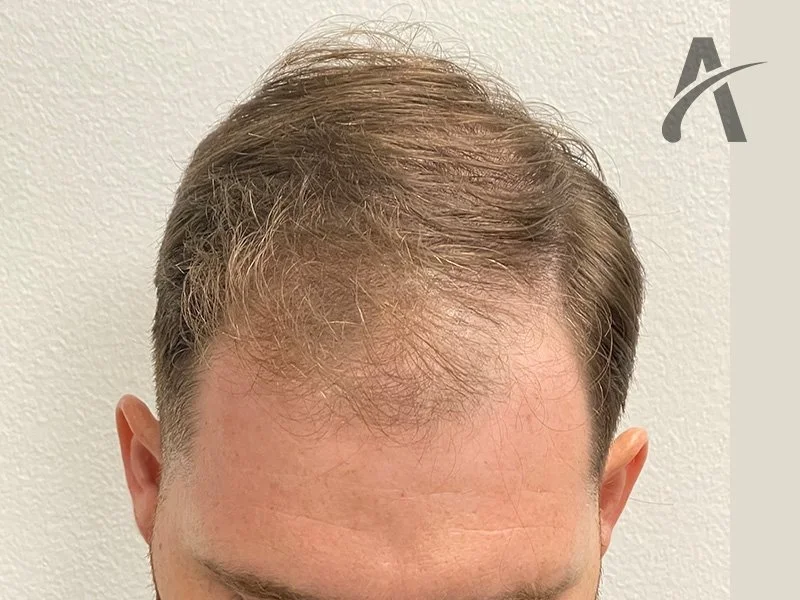 Before 2500 FUE Grafts