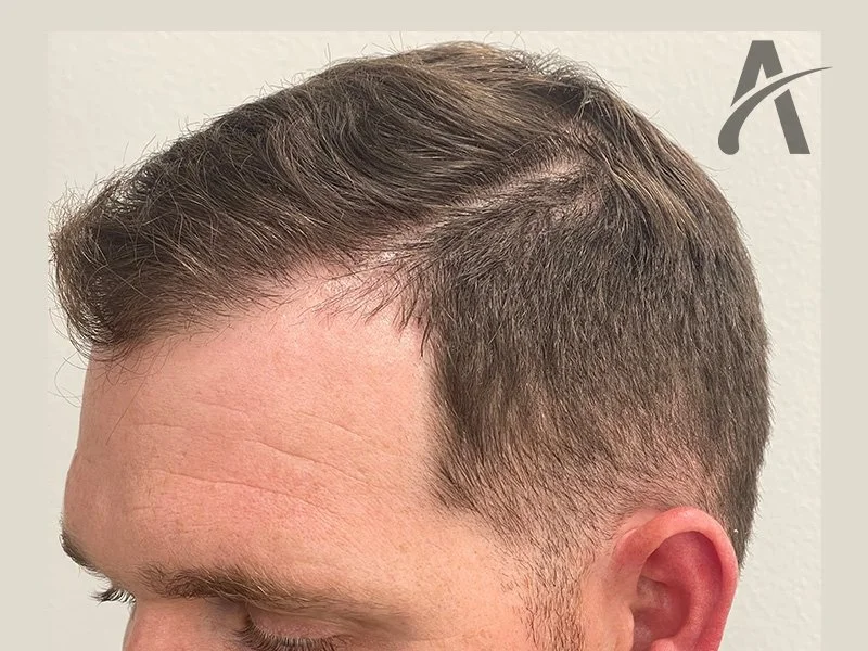 After 2500 FUE Grafts