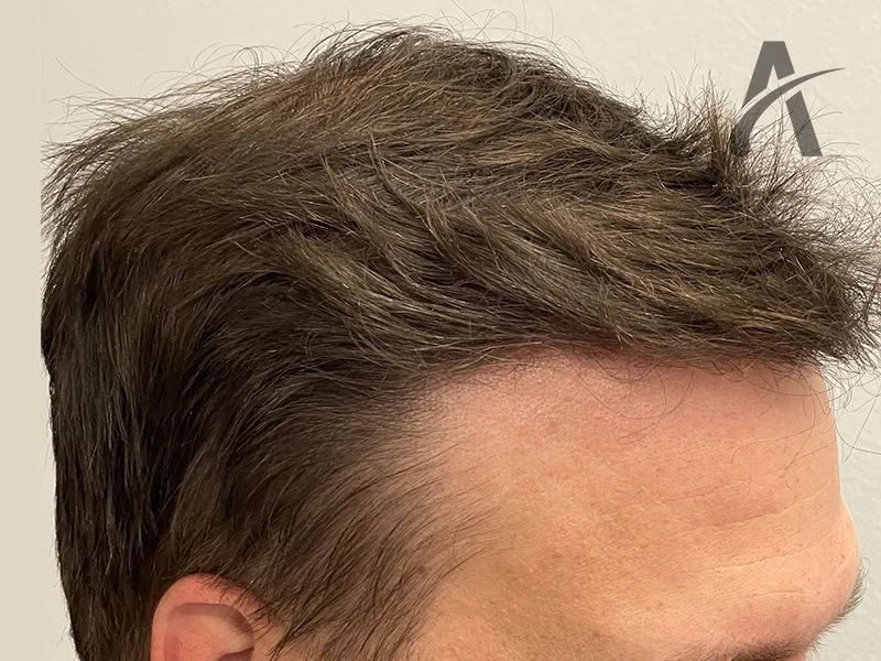 After 2600 FUE Grafts