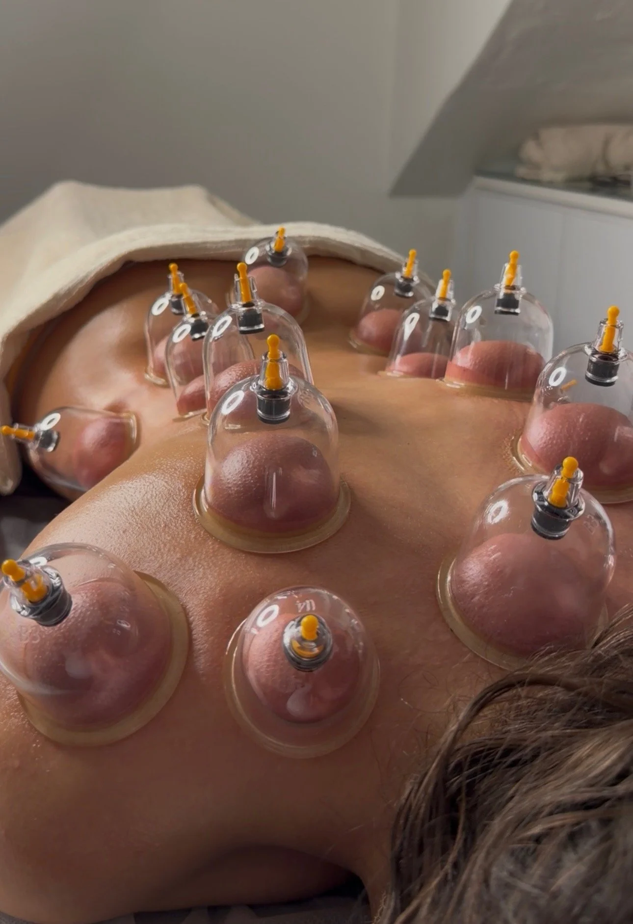 Dry cupping therapy