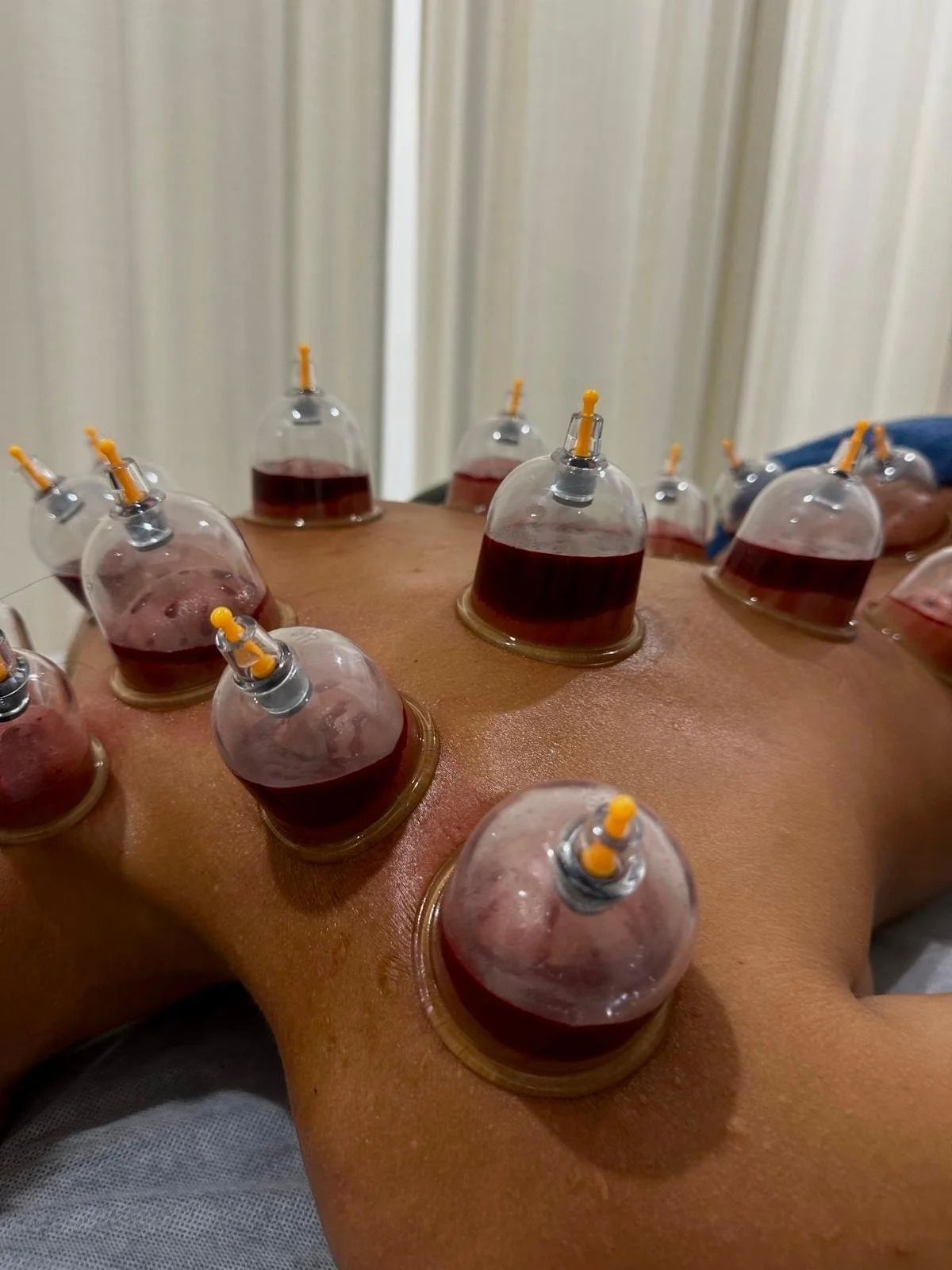 Hijama therapy
