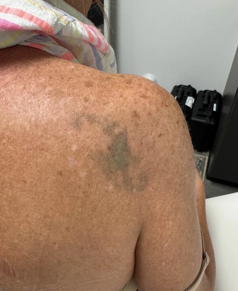 After Tattoo Removal at EAE