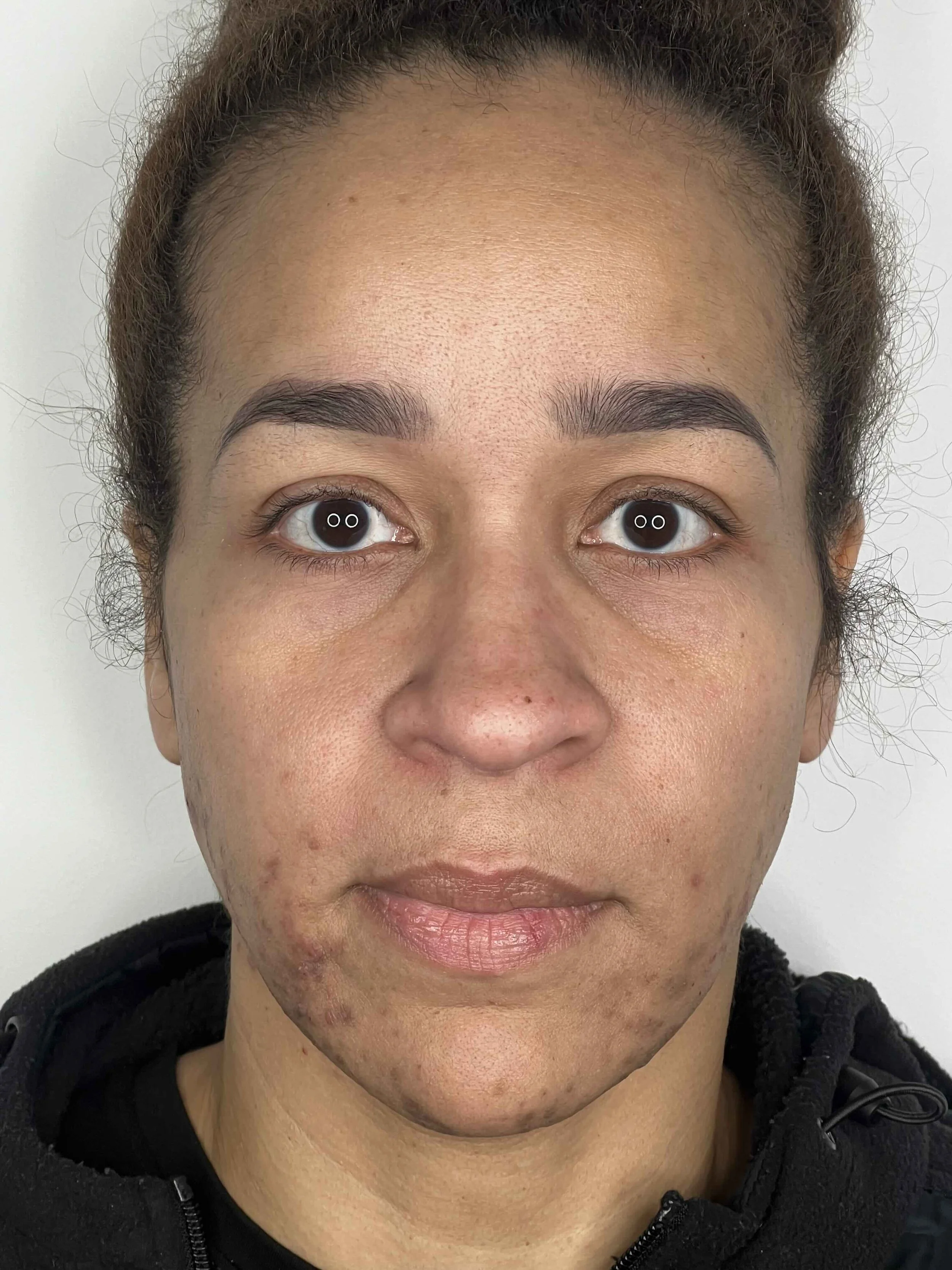 Before 3 mandeliclear chemical peels & laser hair removal at EAE
