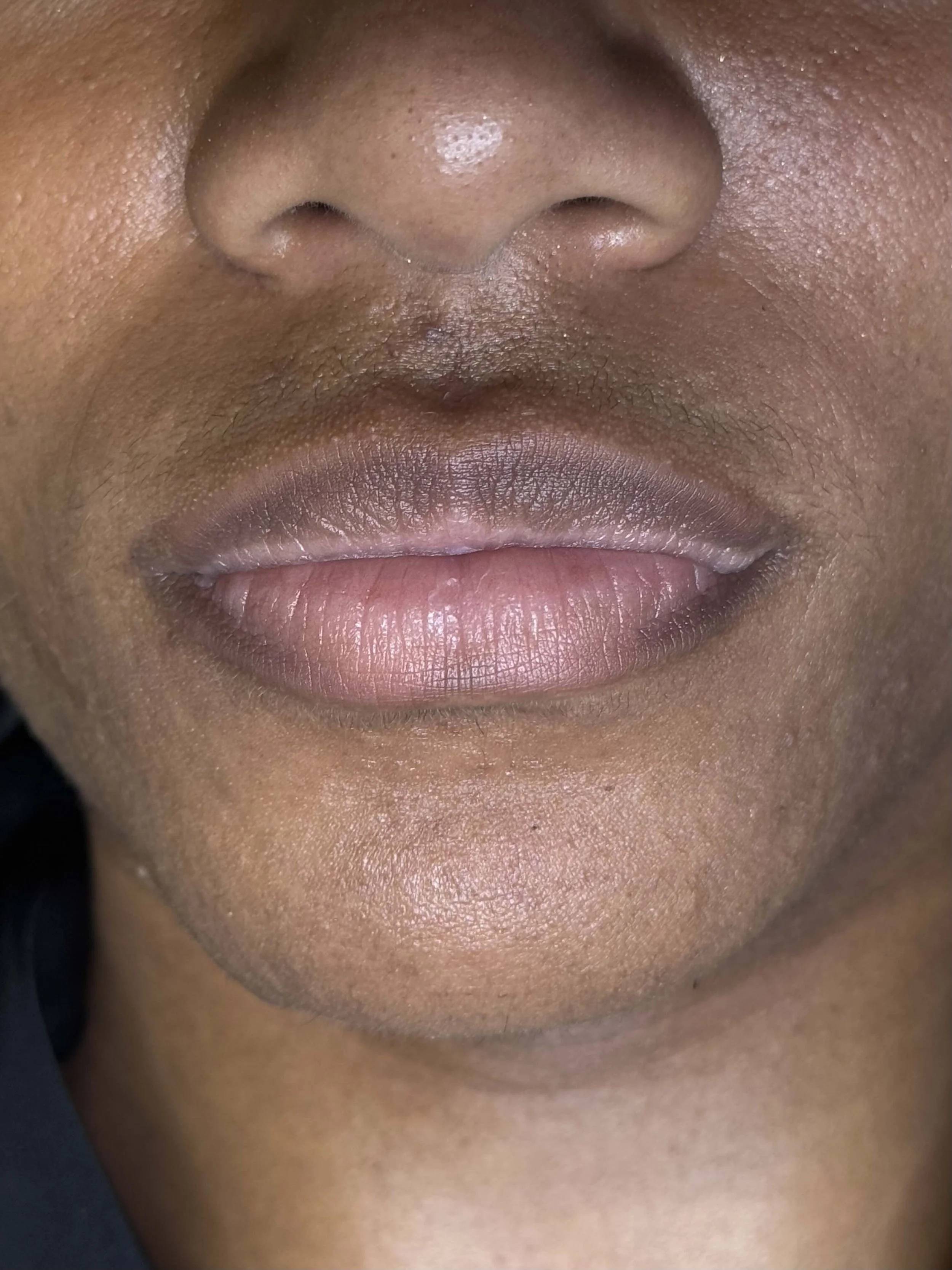 Before pico laser lip neutralization at EAE
