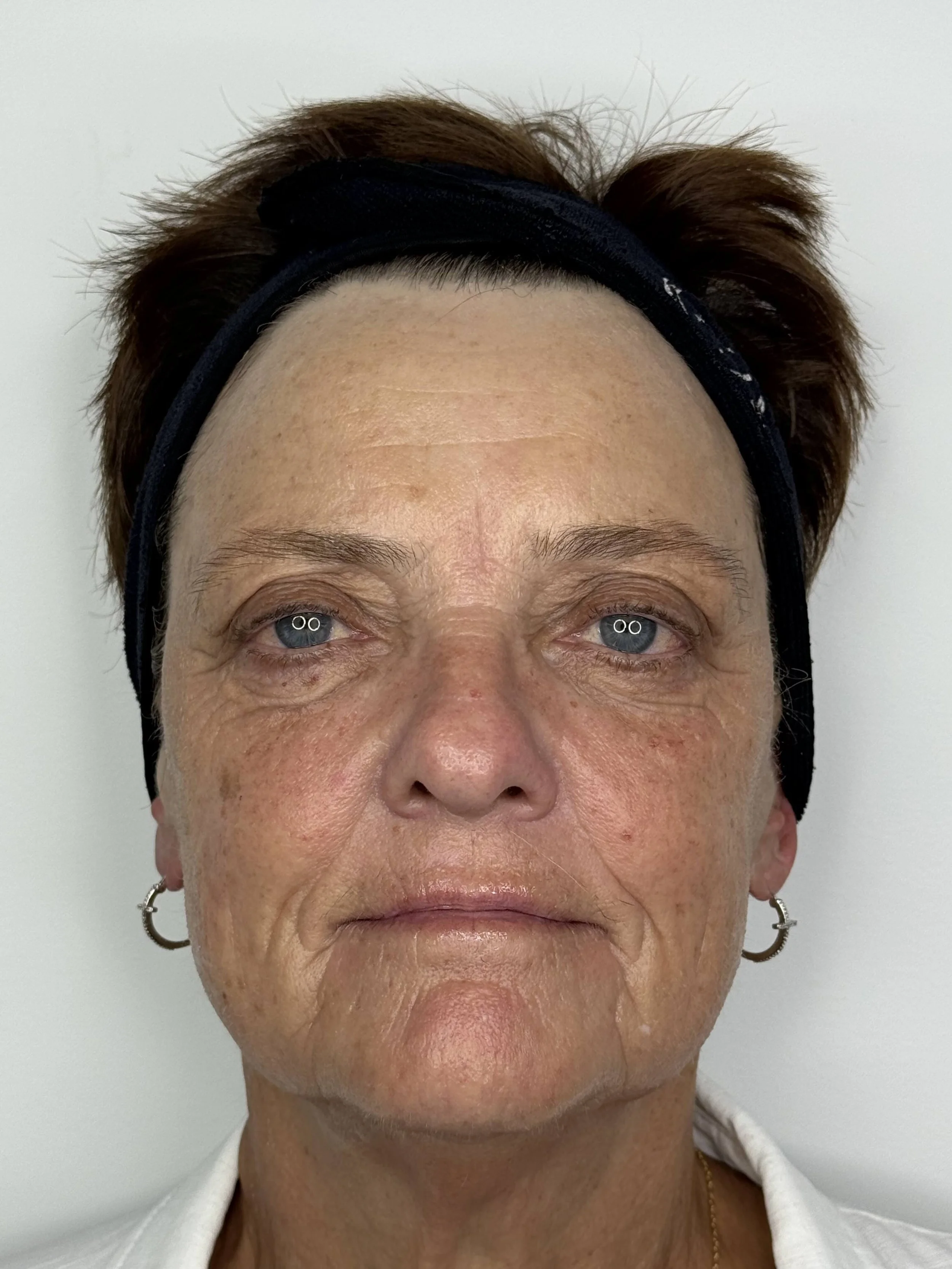 After 3 sessions of circadia sWiCH treatment at EAE