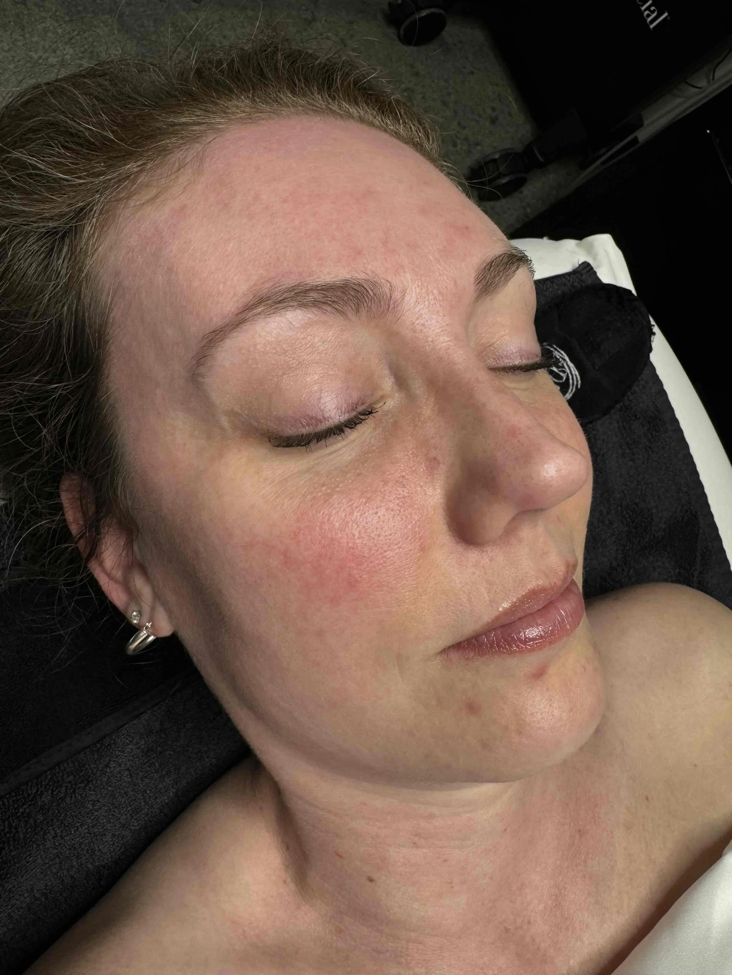 After IPL treatment at EAE