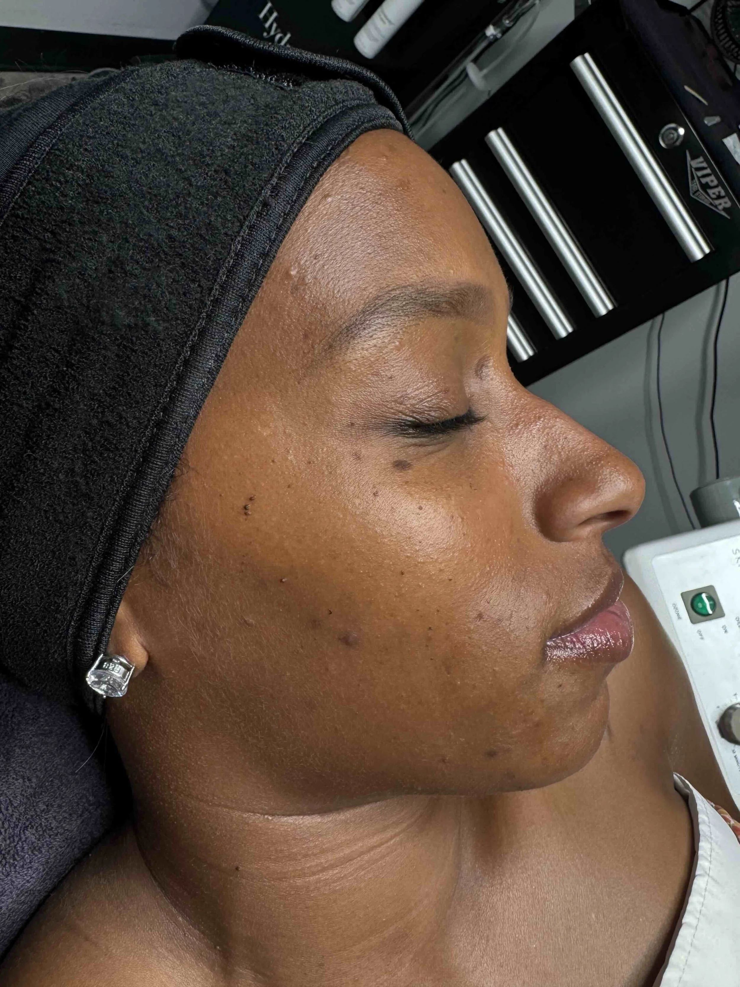 Before Platinum Hydrafacial at EAE