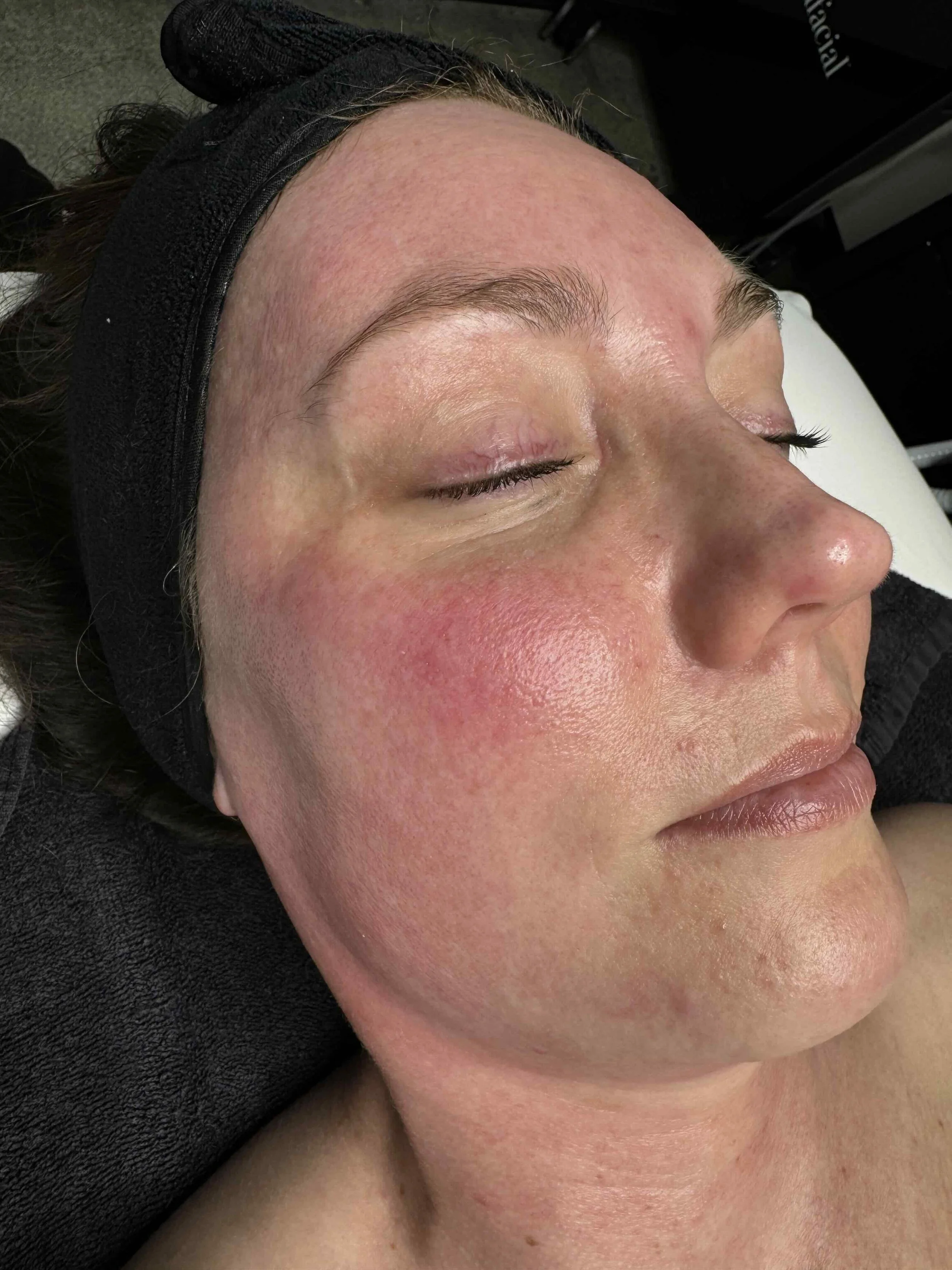 Before IPL treatment at EAE