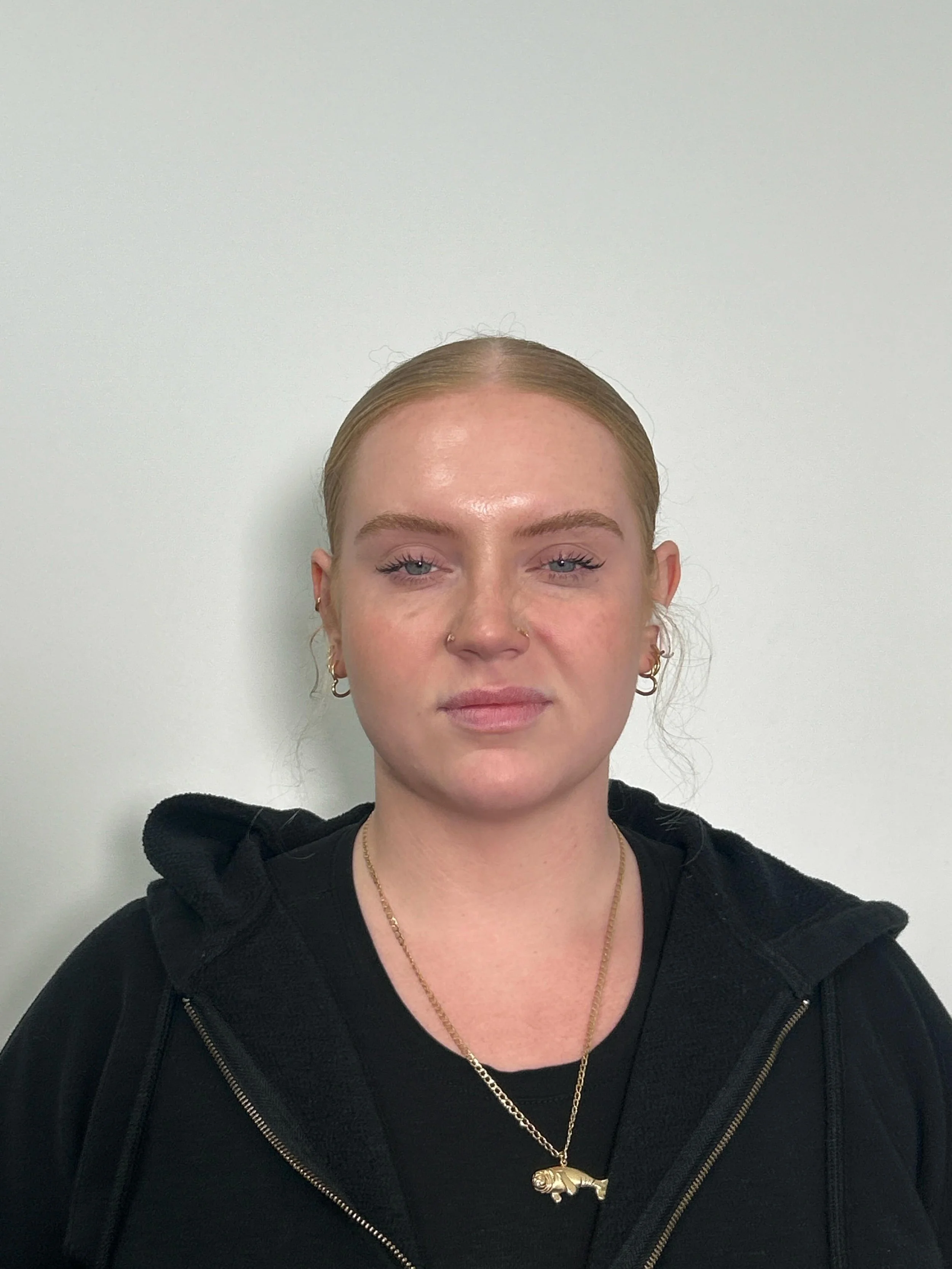 After Botox at EAE