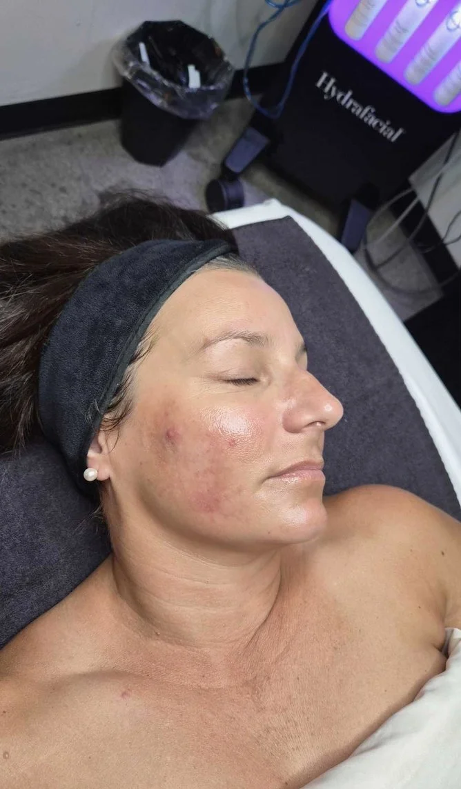 After 3 sessions of Pico laser for Melasma at EAE