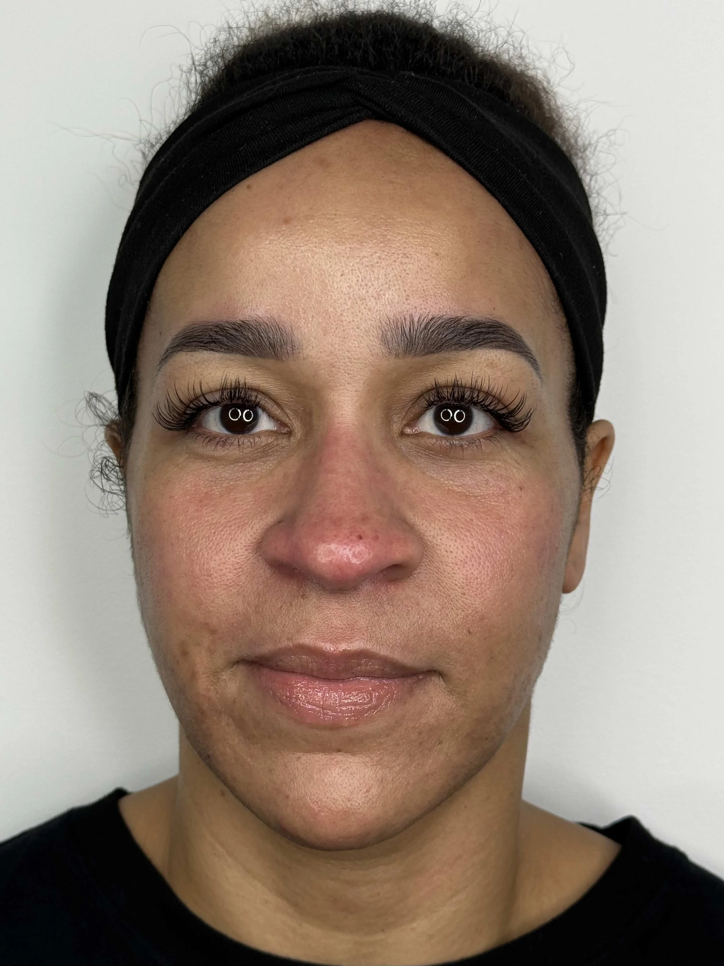 After 3 mandeliclear chemical peels & laser hair removal at EAE