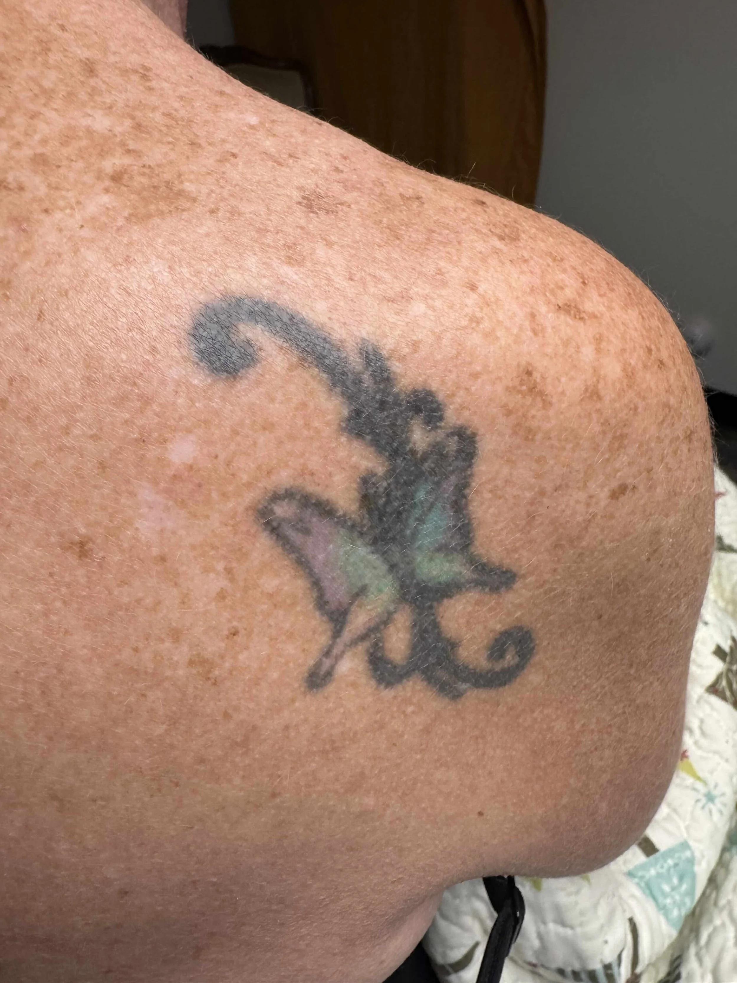 Before Tattoo Removal at EAE