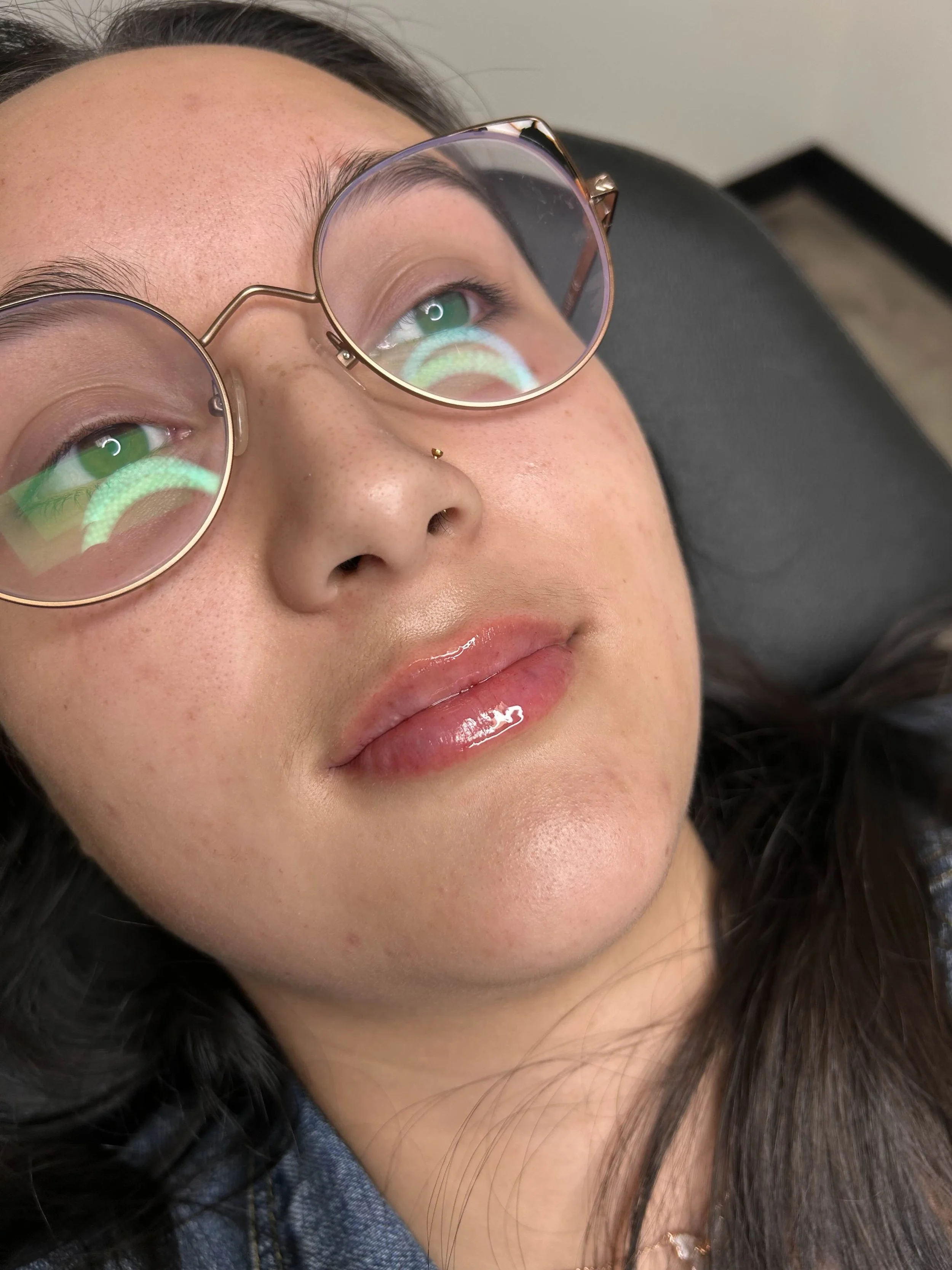 After lip filler at EAE