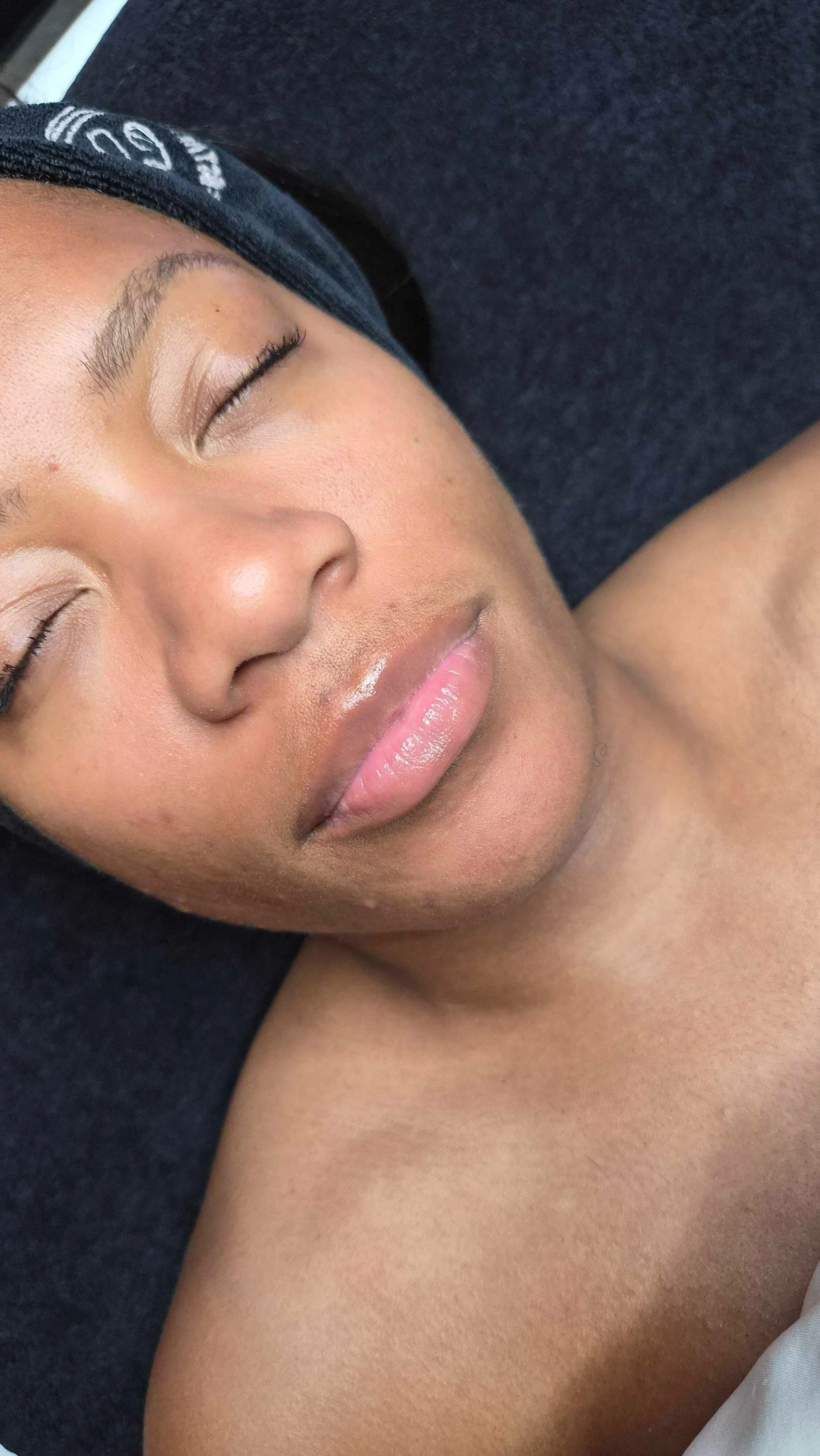 After pico laser lip neutralization