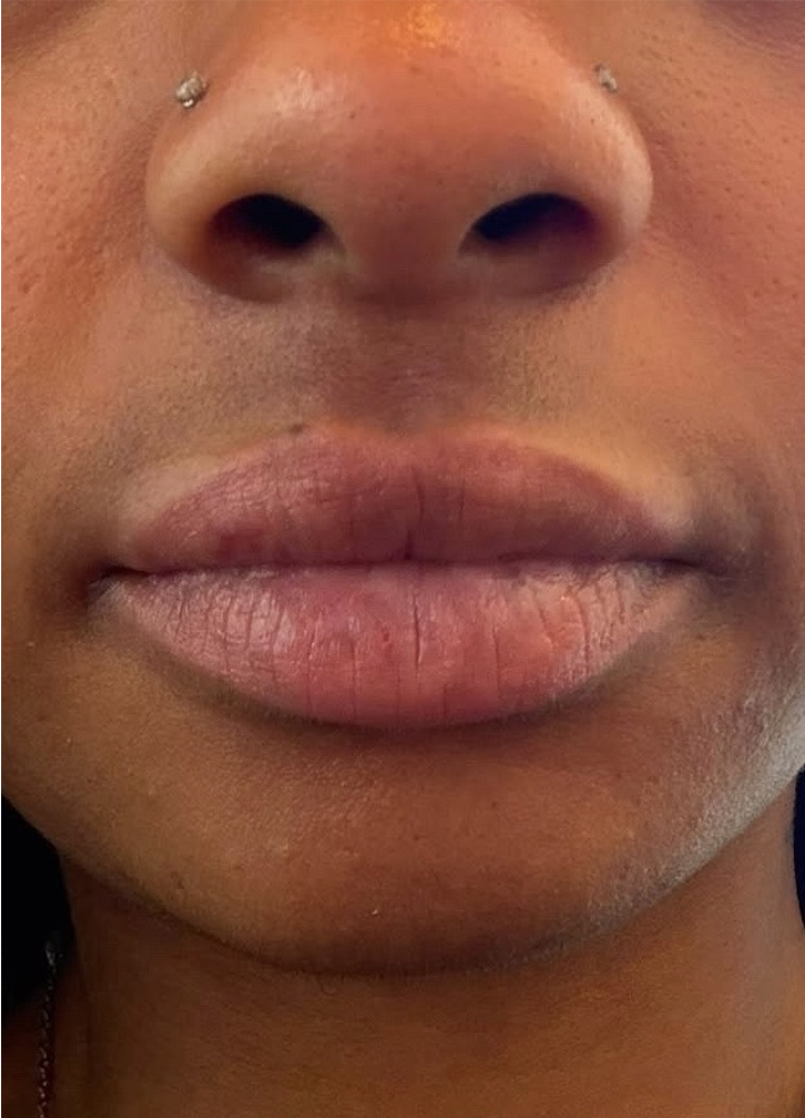 After 1 session of Pico Laser Lip Neutralization