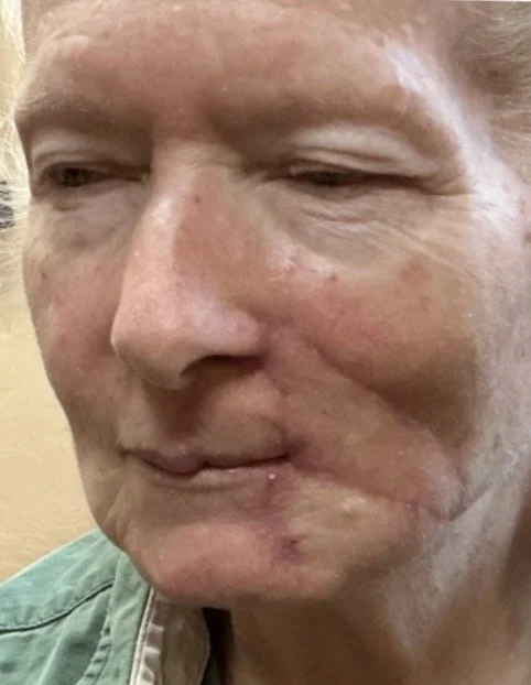 After Mohs reconstruction